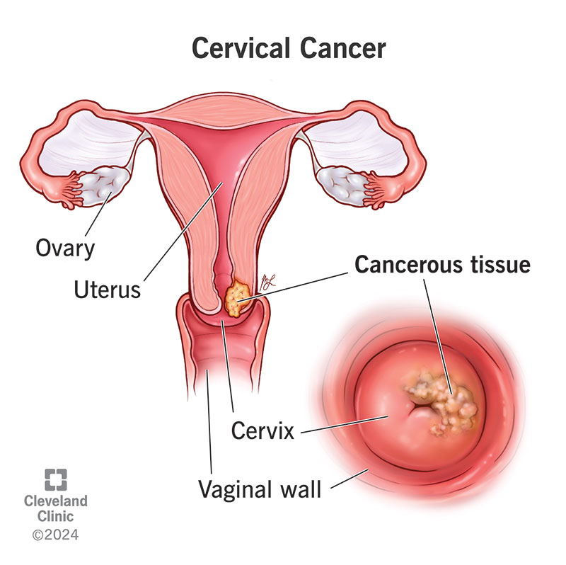 Cervical Cancer in Women: Symptoms, Causes and Prevention Tips