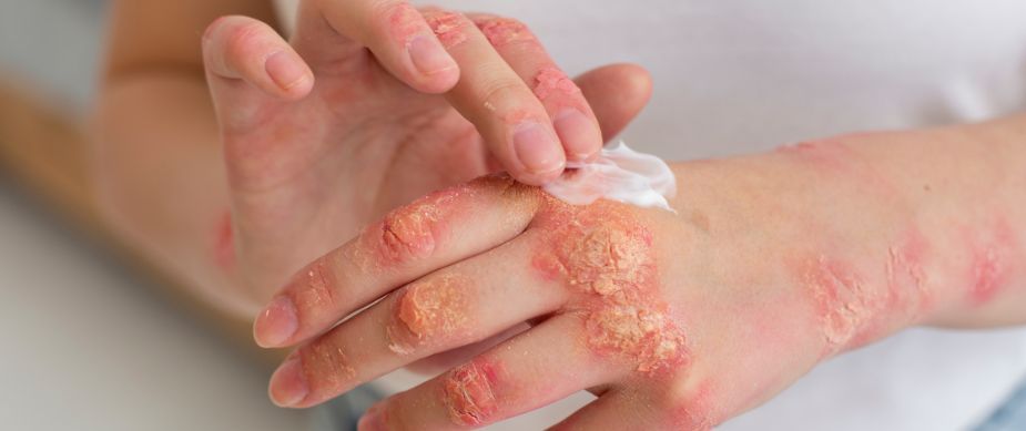 Rise in Fungal Infections in India Raises Public Health Concerns