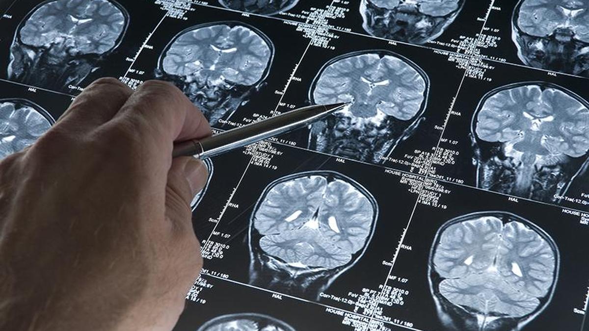 The Unsung Crisis: Why Stroke Rehabilitation Must Move from Margin to Mainstream