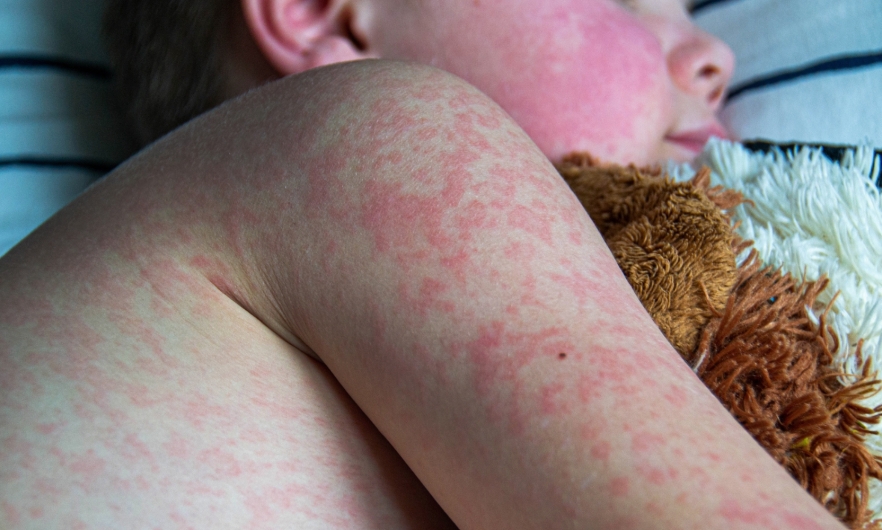 Global Alarm Over Resurgence of Measles and Whooping Cough Amid Falling Vaccination Rates